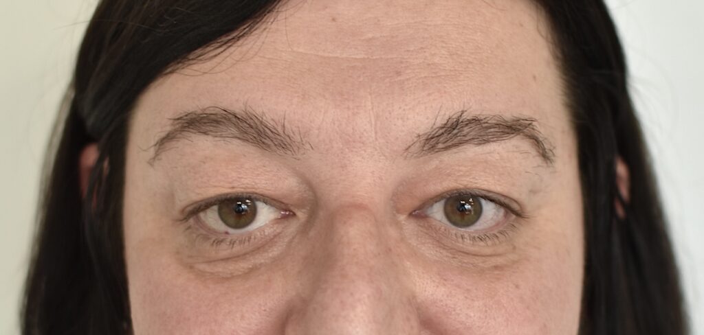 paupières tombantes grenoble dr Delbaere