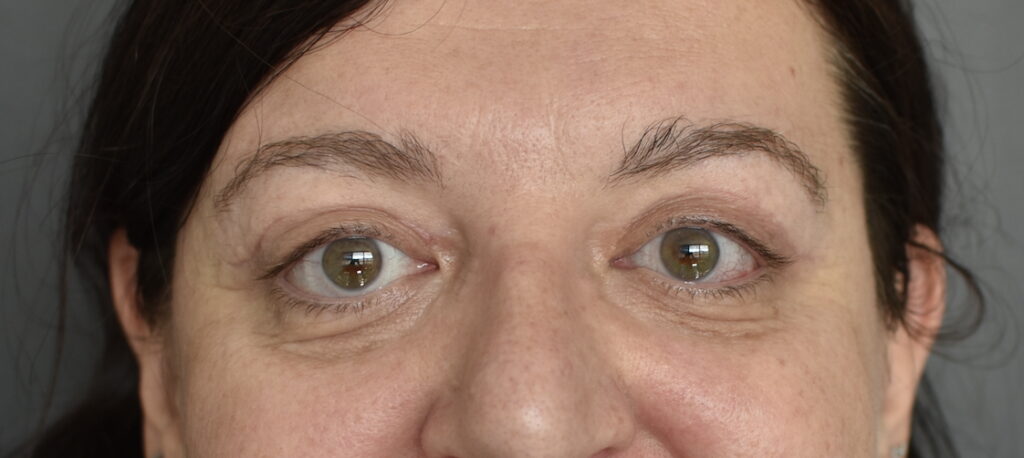 chirurgie des paupières supérieures Rhône Alpes